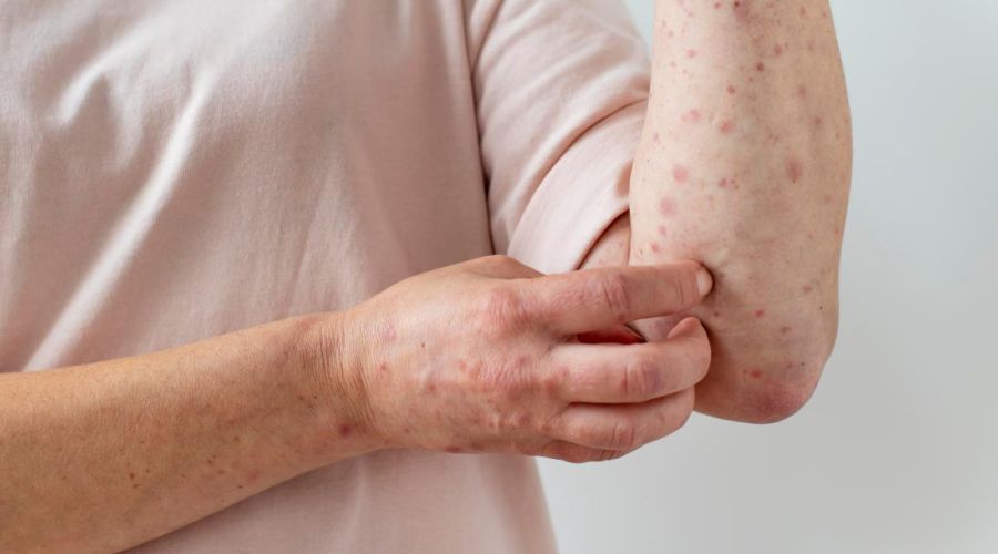 Жители Рубцовска подхватили паразитарную инфекцию после купания в местной старице