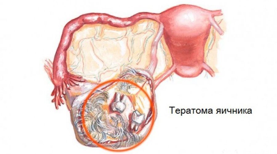 Барнаульские медики избавили ребенка от останков близнеца, поглощенного в утробе матери