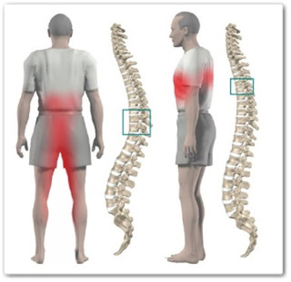 Безоперационное лечение позвоночной грыжи