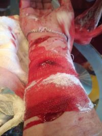 Порезанная рука