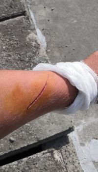 Порез на руке оказался довольно глубоким