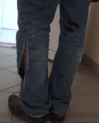 Последствия нападения собаки