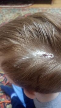 Полученная ребенком ссадина