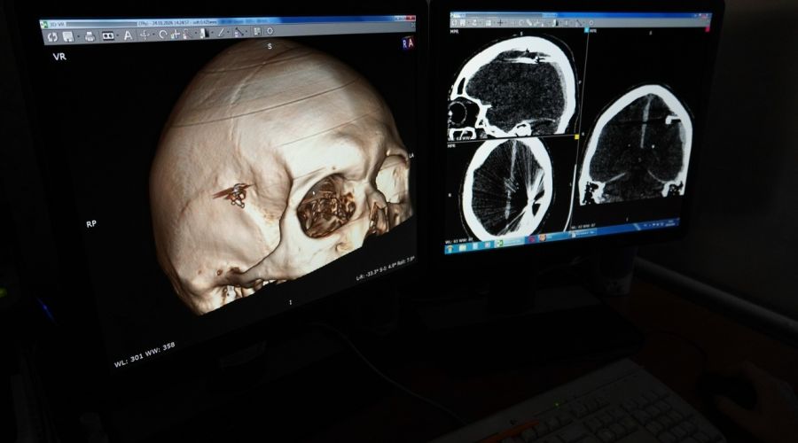 Нейрохирурги ККБСМП спасли пациента, который сутки проходил с пулей в голове
