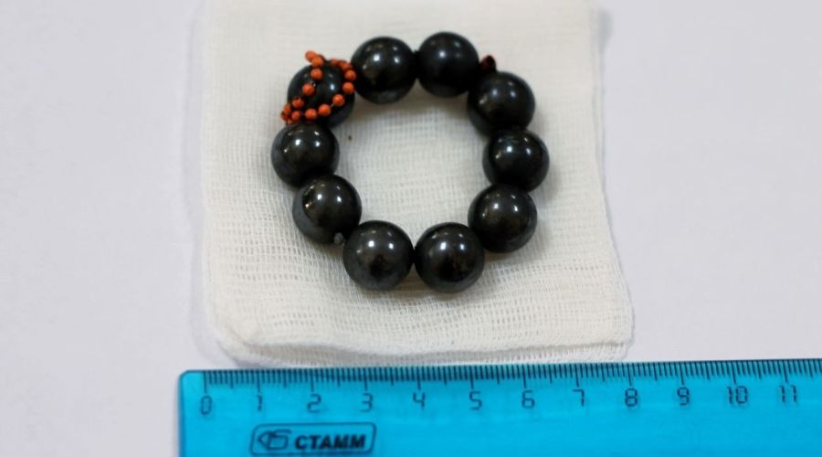 Из желудка 10-летнего мальчика извлекли 10 магнитных шариков