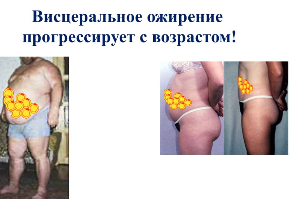 Развитие висцерального ожирения