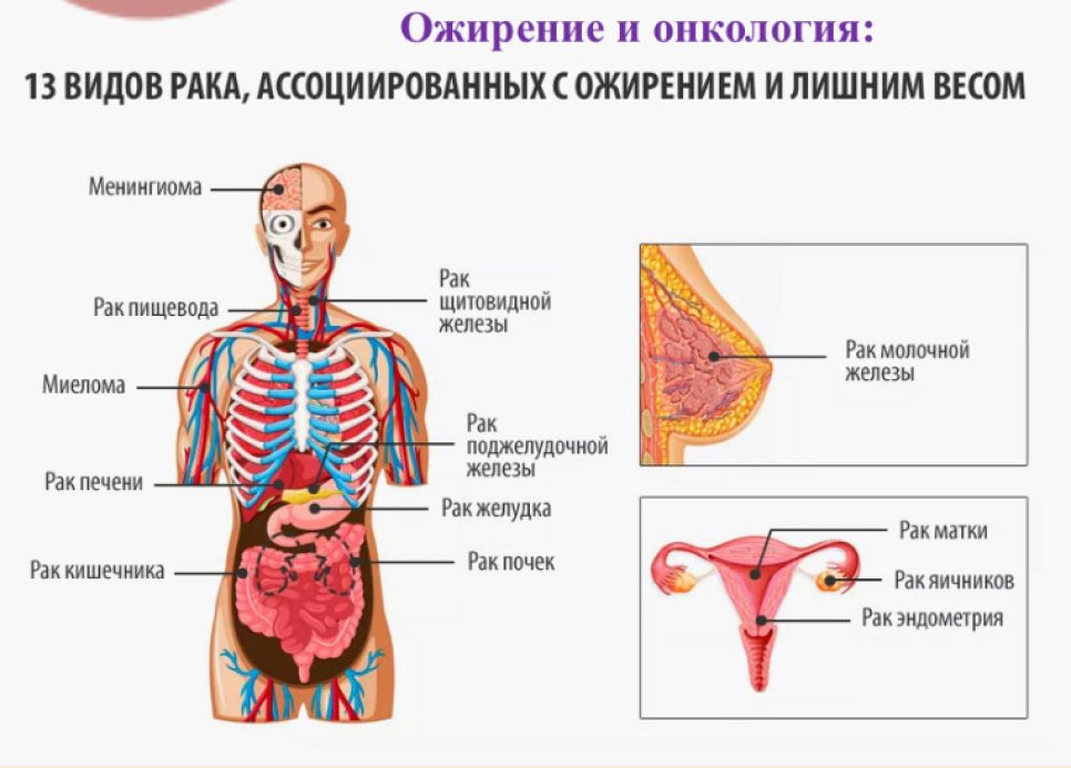 Ожирение и рак